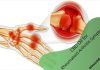 CBD Oil for Rheumatoid Arthritis Symptoms